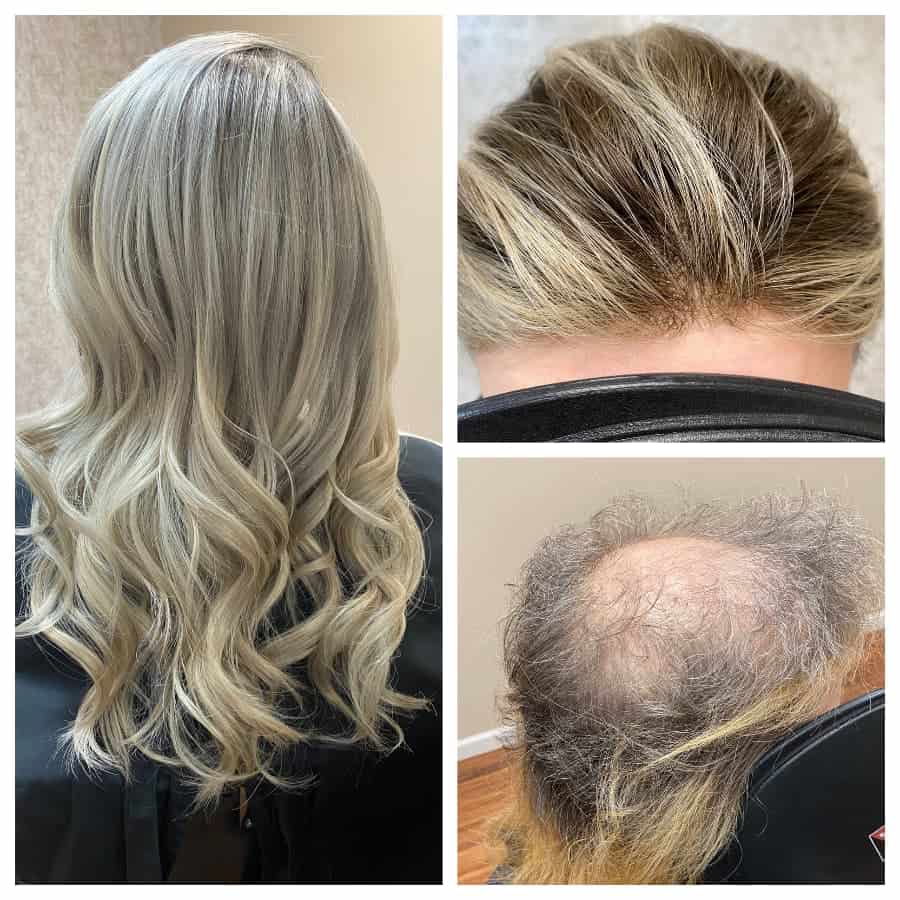 Before and after view of a woman receiving a hair replacement treatment